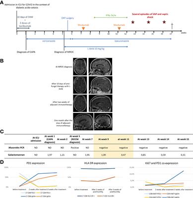 Case Report: Immune Checkpoint Blockade Plus Interferon-Γ Add-On Antifungal Therapy in the Treatment of Refractory Covid-Associated Pulmonary Aspergillosis and Cerebral Mucormycosis